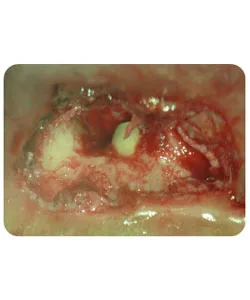 Endodontic surgery, X-ray 1 of 5