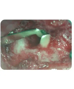 Endodontic surgery, X-ray 2 of 5