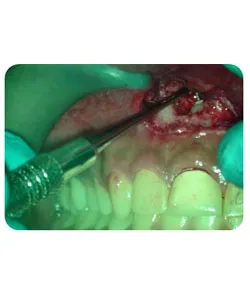 Endodontic surgery, X-ray 3 of 5