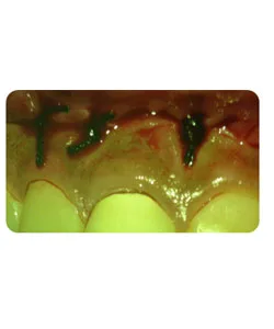Endodontic surgery, X-ray 4 of 5