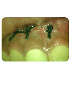Endodontic surgery, X-ray 5 of 5