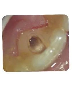 A broken instrument inside the canal, X-ray 1 of 4