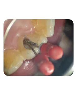 A broken instrument inside the canal, X-ray 2 of 4