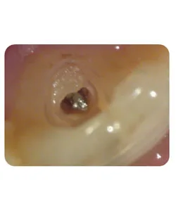 A broken instrument inside the canal, X-ray 4 of 4