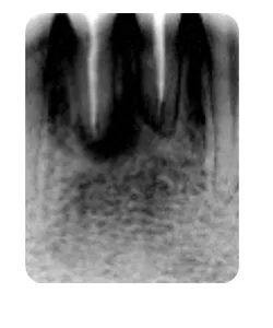 A side branch of the canal, X-ray before