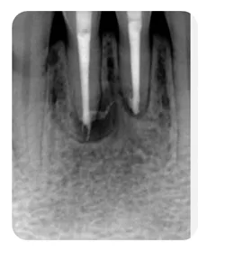 A side branch of the canal, X-ray after