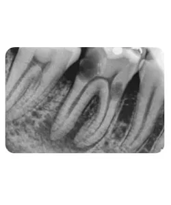 A small extra canal in a lower molar, X-ray 1 of 14