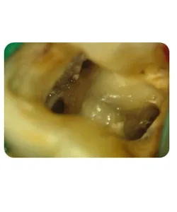 A small extra canal in a lower molar, X-ray 10 of 14