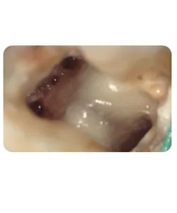 A small extra canal in a lower molar, X-ray 11 of 14