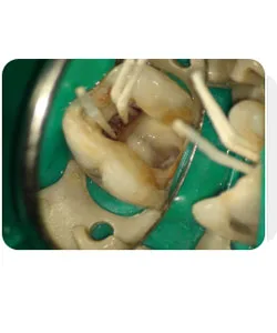 A small extra canal in a lower molar, X-ray 12 of 14