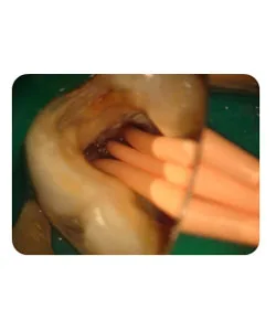A small extra canal in a lower molar, X-ray 13 of 14