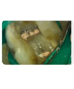 A small extra canal in a lower molar, X-ray 14 of 14