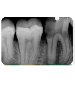 A small extra canal in a lower molar, X-ray 2 of 14