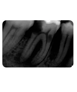 A small extra canal in a lower molar, X-ray 3 of 14