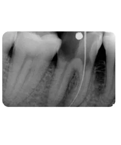 A small extra canal in a lower molar, X-ray 4 of 14