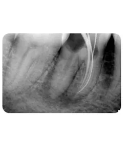 A small extra canal in a lower molar, X-ray 5 of 14