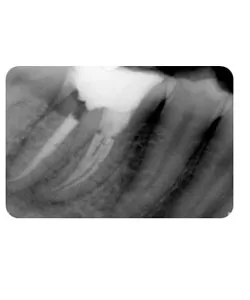A small extra canal in a lower molar, X-ray 6 of 14