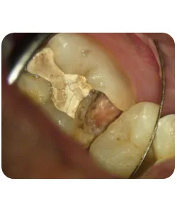 A small extra canal in a lower molar, X-ray 7 of 14