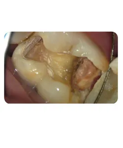 A small extra canal in a lower molar, X-ray 8 of 14