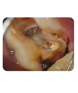 A small extra canal in a lower molar, X-ray 9 of 14