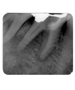 X-ray before treatment of a missed canal