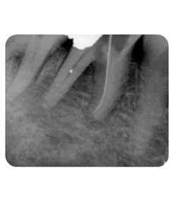 A canal that was missed, X-ray canal found