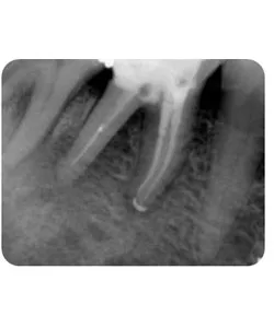 X-ray after the missed canal was treated