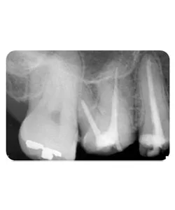 An opening through the root, X-ray 1 of 4