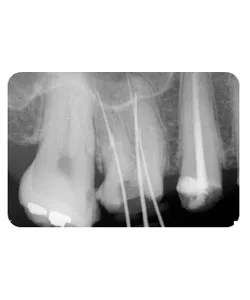An opening through the root, X-ray 2 of 4