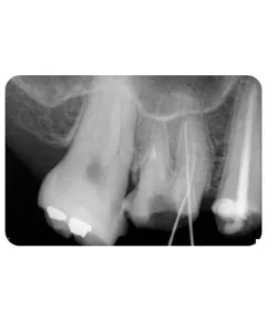 An opening through the root, X-ray 3 of 4