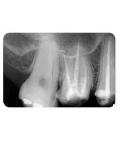 An opening through the root, X-ray 4 of 4