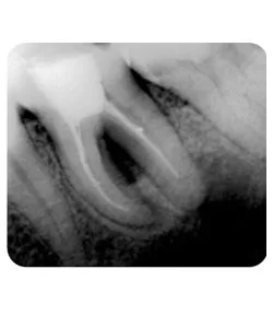 X-ray before retreatment