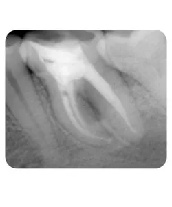 X-ray after retreatment