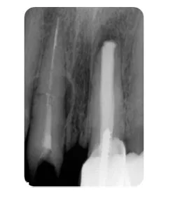 X-ray of a root fracture before treatment