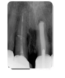 X-ray of the same tooth after treatment